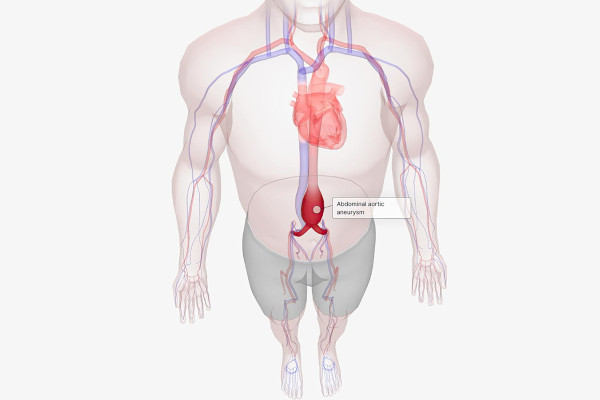 Ανεύρυσμα κοιλιακής αορτής: Τι είναι και ποια τα συμπτώματα